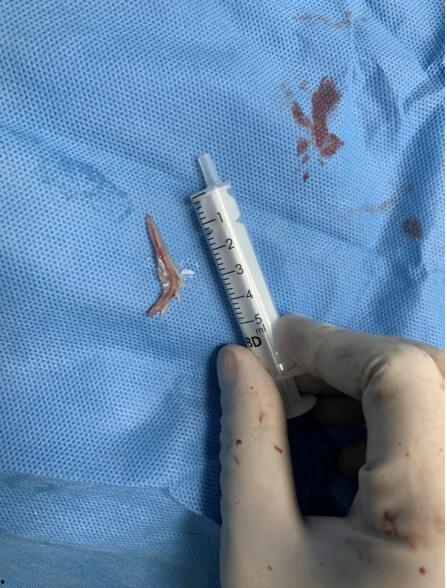 取鱼刺视频,视频教你如何巧妙取鱼刺