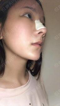 做鼻子视频过程,从术前准备到术后恢复